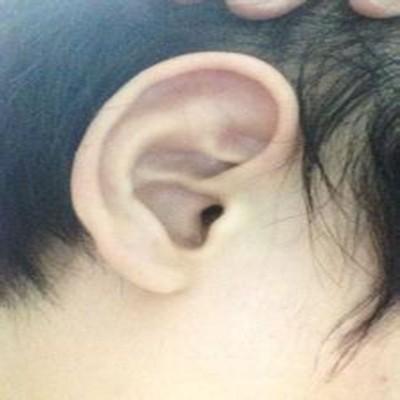 耳后根长疙瘩怎么办（耳后根长了个疙瘩怎么办）