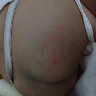屁股上长疙瘩是什么原因（夏天屁股上长疙瘩是什么原因）
