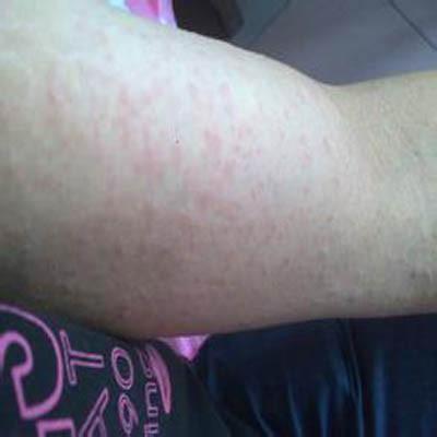 身上突然起红疙瘩很痒怎么办 身上突然起红疙瘩很痒怎么办啊