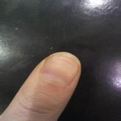 指甲上有横纹凹陷是怎么回事 每个手指甲上有横纹凹陷是怎么回事