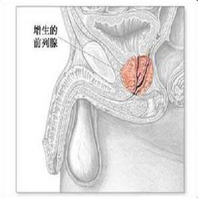 前列腺增生手术费用是多少（前列腺增生手术费用大概多少）