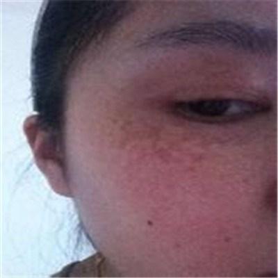 宫毒斑怎么日常护理（宫毒斑是怎么回事）