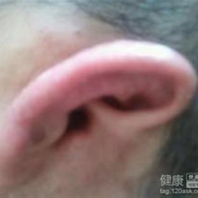 白癜风怎么办（白点癫风怎么治疗）