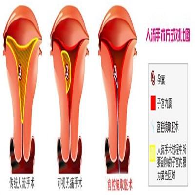 宫腔镜手术怎么样 人流做宫腔镜手术怎么样