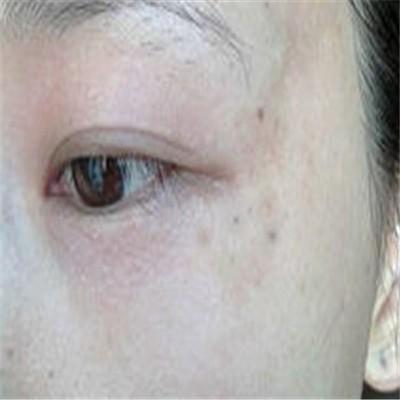 眼角长斑是怎么回事 右眼眼角长斑是怎么回事