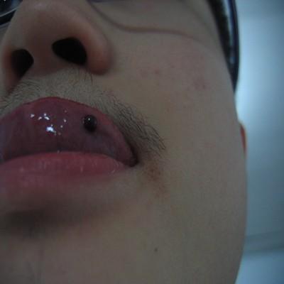 舌头血泡怎么办 舌头起血泡怎么处理