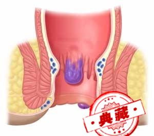 怎样用无花果巧治痔疮（怎样用无花果治痔疮办法）