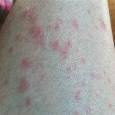 泛发型湿疹怎么治疗 泛发性湿疹怎么治疗才能好