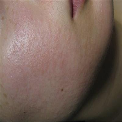 治疗湿疹最好的药膏 治疗湿疹最好的药膏有哪些