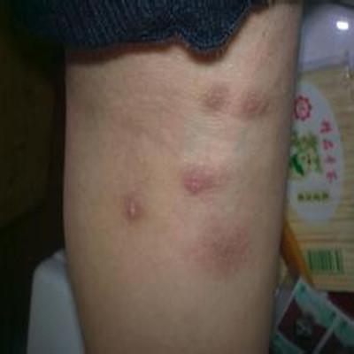 疥疮怎么治疗好（疥疮怎么治疗才能除根）