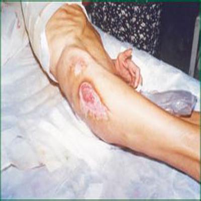 褥疮的治疗方法有哪些（褥疮的治疗方法有哪些忌口）