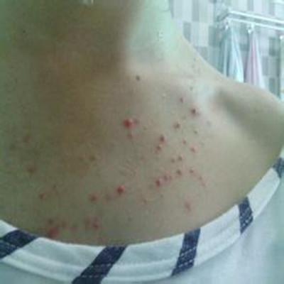 后背长痘痘怎么办才好呢 后背长痘痘该怎么办