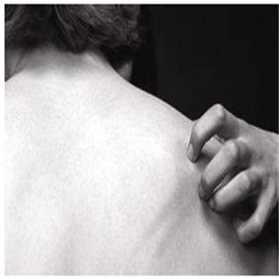 神经性皮炎用什么药 神经性皮炎用什么药好