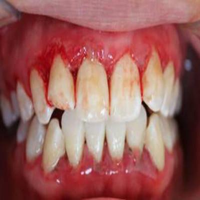 女性牙龈出血怎么办（女生牙龈出血怎么办）