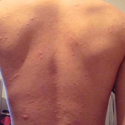 神经性皮炎怎么治 眼皮上长神经性皮炎怎么治