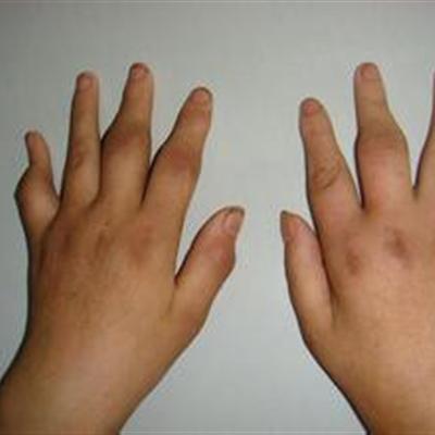 类风湿能治好吗（手指关节类风湿能治好吗）