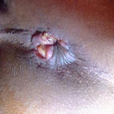 痔疮会癌变吗（痔疮会癌变吗?应注意什么）