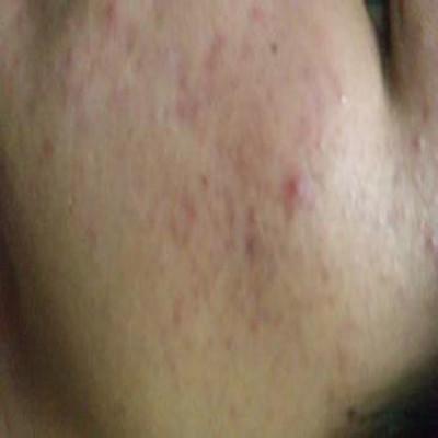 脸上痘印怎么快速去除（脸上的痘印如何快速去除）