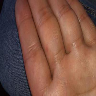 手指疱疹怎么办（手指疱疹怎么办图片）