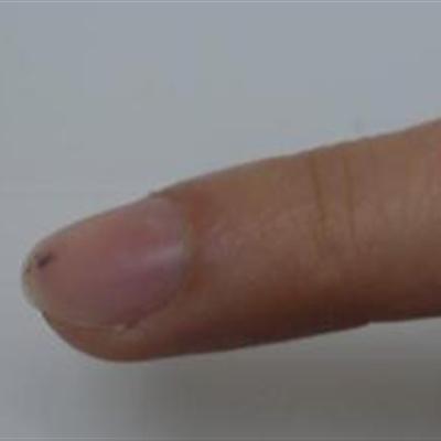 指甲上有黑线是什么问题（指甲上有黑线是怎么回事?）