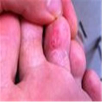 红红的有水泡是什么皮肤病（皮肤出现红水泡）