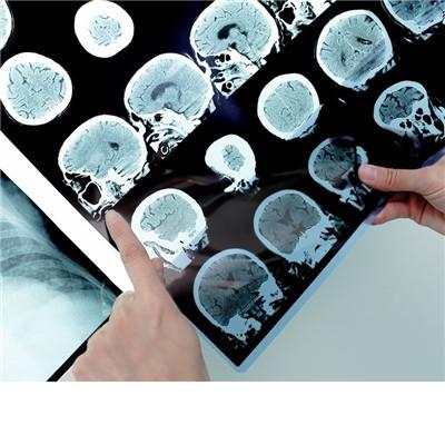 结核性脑膜炎怎么办 结核性脑膜炎怎么治