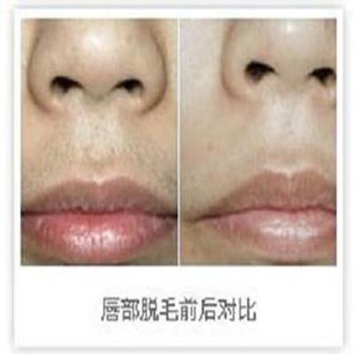 激光脱唇毛需要几次（激光脱唇毛需要几次才能好）