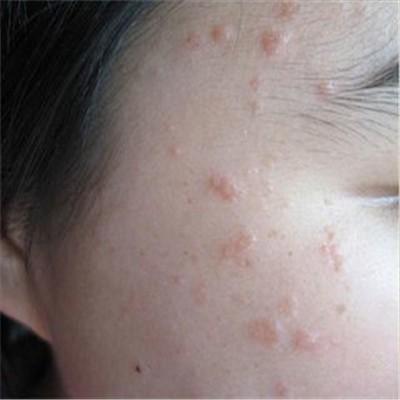 扁平疣会自己好吗 得了扁平疣会自己好吗