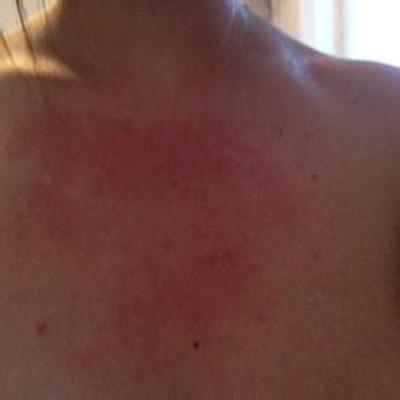 蛇盘疮最佳治疗方法是什么 蛇盘疮最佳治疗方法是什么药