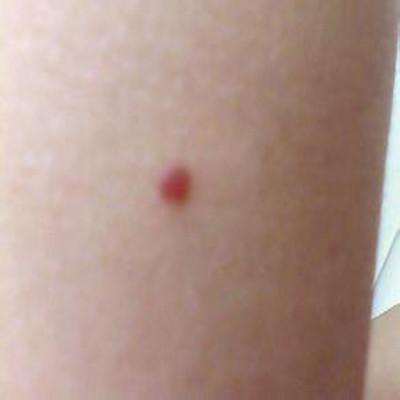 血管痣怎么办 脸上长血管痣怎么办