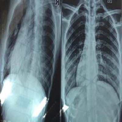 肋骨骨折多久能好 第五肋骨骨折多久能好