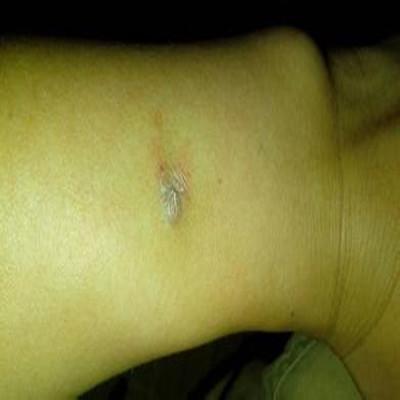 鱼痣怎么治（鱼痣怎么治愈）