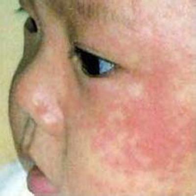 风疹最佳治疗方法是什么 治疗风疹的方法