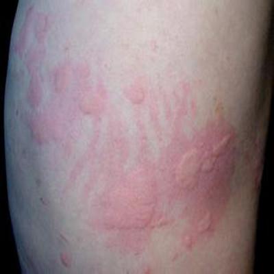 血虚风燥型荨麻疹怎么办（慢性荨麻疹血虚生风）