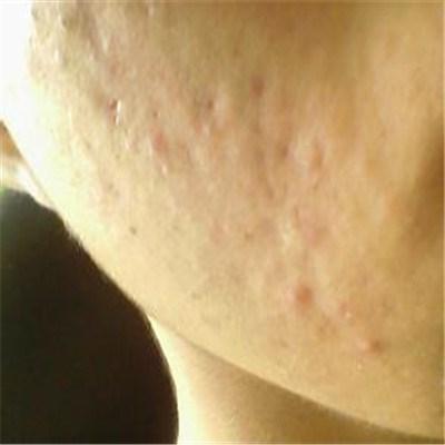 痘印怎么消除 红色痘印怎么消除