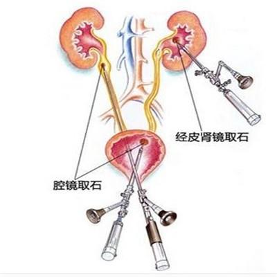 肾结石微创手术有什么风险（微创肾结石手术有风险吗）