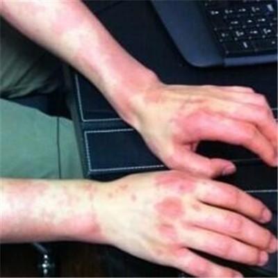 酒精过敏吃什么药 酒精过敏吃什么药可以预防