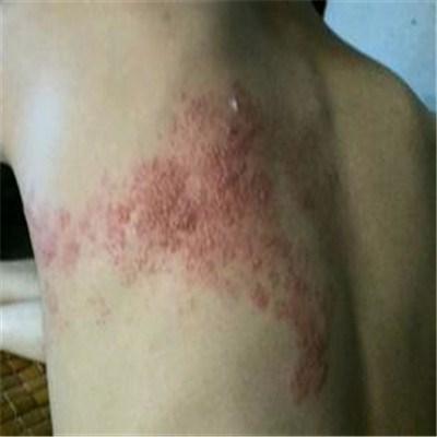 病毒性疱疹的症状是什么 疱疹病毒的症状表现是什么
