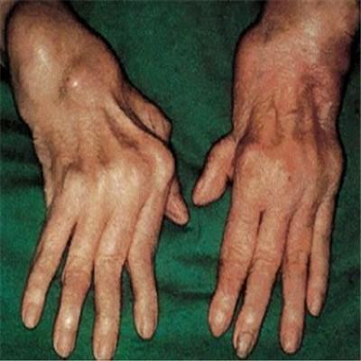 类风湿关节炎有什么治疗方法 类风湿关节炎 治疗方法