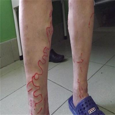 静脉曲张能泡脚吗 静脉曲张能泡脚吗?里面放什么好?