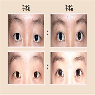 双眼皮埋线多久恢复（双眼皮埋线多久恢复自然）