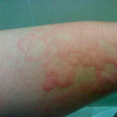 小儿丘疹性寻麻疹怎么治疗 丘疹型寻麻疹能治好吗