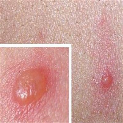 带状疱疹看什么科 带状疱疹什么科室治疗 百度百科