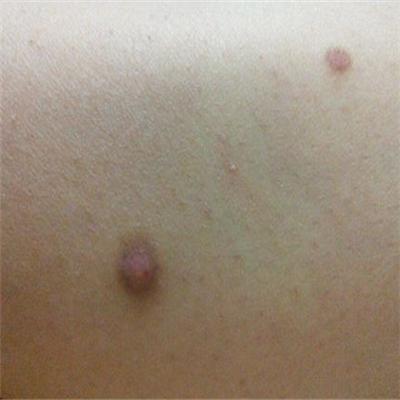 身上起红疙瘩很痒怎么回事 孩子身上起红疙瘩很痒怎么回事