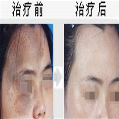 点痣的最好方法 点痣的最好方法