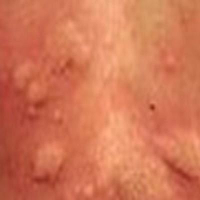 寻麻疹症状是什么（寻麻疹是什么样子的症状）