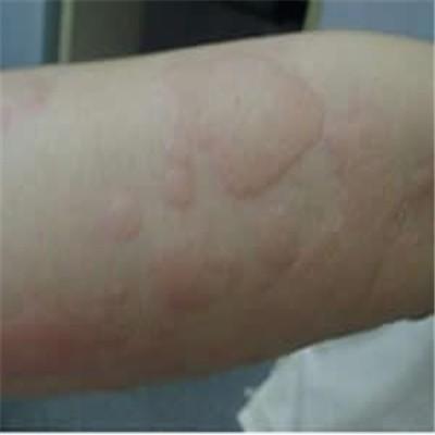 破伤风针过敏怎么办（打完破伤风针过敏怎么办）