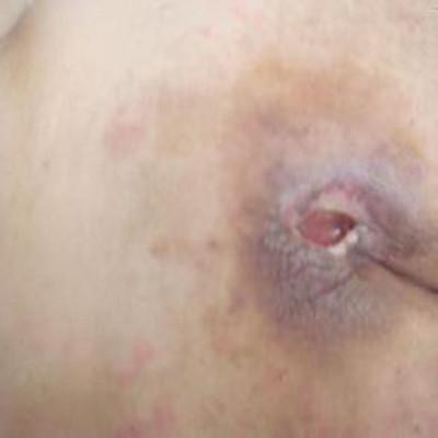 褥疮治疗土方法有哪些（沙土治褥疮有用吗）