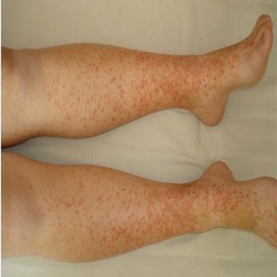 怎么治疗白癜风