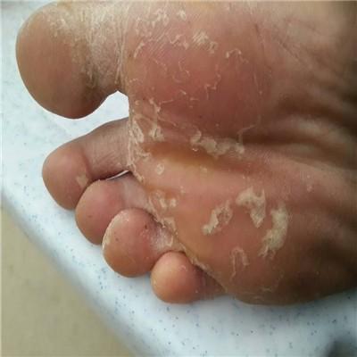 脚底脱皮是什么原因 女性脚底脱皮是什么原因